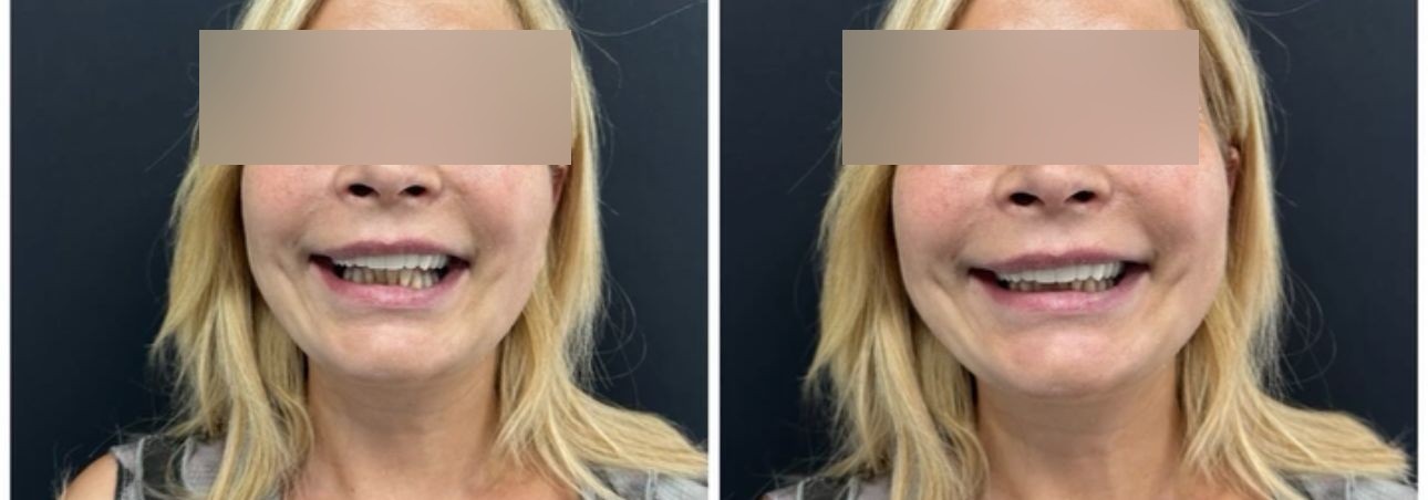 Vorher und nachher eines Smile Makeovers – lückige, abgenutzte obere Zähne mit Zirkonkronen und Bleaching wiederhergestellt für ein gleichmäßiges Lächeln in natürlichem Farbton
